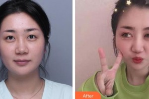 合肥愛爾眼科醫(yī)院陳誠整形價格表附眼部綜合案例展示