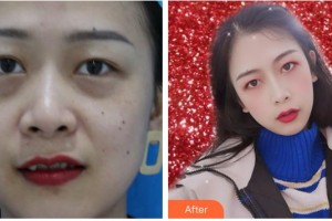 合肥愛爾眼科醫(yī)院張玉整形價格表附祛眼袋案例展示