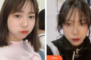 合肥愛(ài)爾眼科醫(yī)院曹艷整形價(jià)格表附眼部綜合案例展示