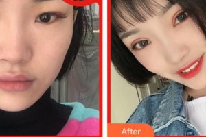 合肥愛(ài)爾眼科醫(yī)院劉平整形價(jià)格表附眼修復(fù)案例展示