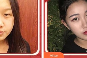 合肥愛(ài)爾眼科醫(yī)院王朝庭整形價(jià)格表附眼部綜合案例展示