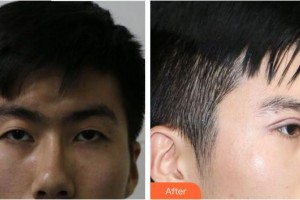 合肥愛(ài)爾眼科醫(yī)院李萍整形價(jià)格表附埋線雙眼皮案例展示