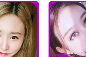 合肥愛(ài)爾眼科醫(yī)院遲強(qiáng)強(qiáng)整形價(jià)格表附眼部綜合案例展示