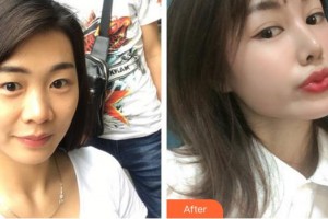 合肥愛(ài)爾眼科醫(yī)院郭云飛整形價(jià)格表附定點(diǎn)雙眼皮案例展示