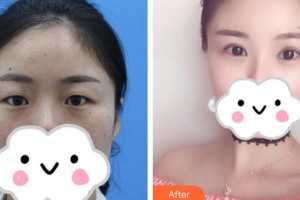 合肥愛(ài)爾眼科醫(yī)院楊秀敏整形價(jià)格表附眼部綜合案例展示