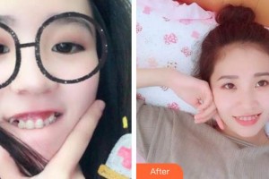 合肥瑞特曼口腔門(mén)診部金多貴整形價(jià)格表附牙齒矯正案例展示