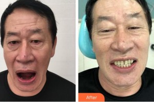 合肥瑞特曼口腔門(mén)診部魏敬謙整形價(jià)格表附種植牙案例展示