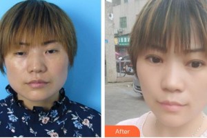 合肥東南眼科醫(yī)院葉玉華整形價(jià)格表附上瞼下垂、內(nèi)眼角案例展示