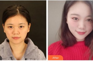 合肥東南眼科醫(yī)院黃蓓整形價(jià)格表附外切祛眼袋案例展示