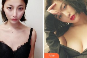 蕪湖蘭華醫(yī)療美容診所趙啟明整形價(jià)格表附假體隆胸案例展示