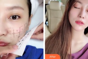 蕪湖伊萊美整形醫(yī)院賈利霞整形價(jià)格表附熱瑪吉案例展示