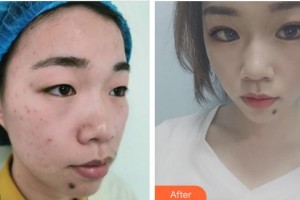 蕪湖伊萊美整形醫(yī)院田軍整形價(jià)格表附定點(diǎn)雙眼皮案例展示