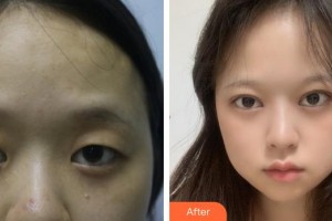 蕪湖伊萊美整形醫(yī)院馮思陽(yáng)整形價(jià)格表附眼部綜合案例展示