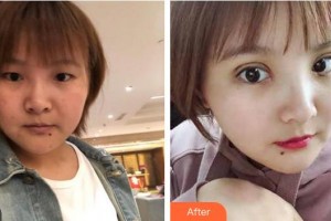 蕪湖瑞麗醫(yī)療美容門(mén)診部王俞明整形價(jià)格表附切開(kāi)雙眼皮案例展示