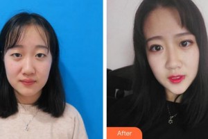 蕪湖壹加壹整形美容醫(yī)院王海龍整形價(jià)格表附定點(diǎn)雙眼皮案例展示