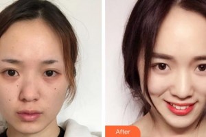 蕪湖壹加壹整形美容醫(yī)院時(shí)偉整形價(jià)格表附鼻部綜合案例展示