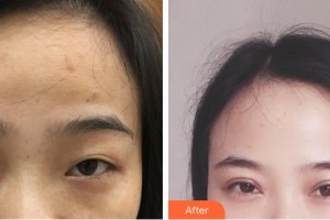 蕪湖一秒醫(yī)療美容醫(yī)院邢程整形價(jià)格表附眼部綜合案例展示