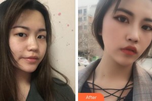 蕪湖一秒醫(yī)療美容醫(yī)院樸成浩整形價(jià)格表附眼部綜合案例展示