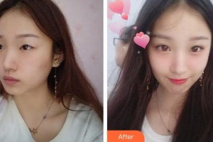 蕪湖一秒醫(yī)療美容醫(yī)院劉明明整形價(jià)格表附眼部綜合案例展示