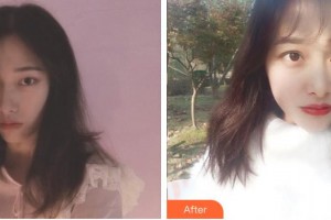 蕪湖眼科醫(yī)院（弋江區(qū)醫(yī)院）汪亮整形價(jià)格表附切開雙眼皮案例展示