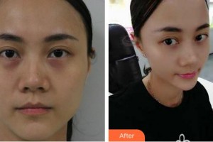 蕪湖眼科醫(yī)院（弋江區(qū)醫(yī)院）周麗整形價(jià)格表附雙眼皮案例展示