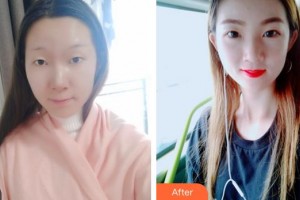 蕪湖眼科醫(yī)院（弋江區(qū)醫(yī)院）韓林峰整形價(jià)格表附切開雙眼皮案例展示