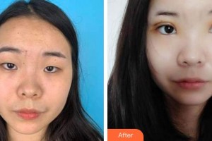 蕪湖眼科醫(yī)院（弋江區(qū)醫(yī)院）王繼兵整形價(jià)格表附外切祛眼袋案例展示