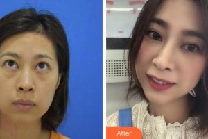 蕪湖眼科醫(yī)院（弋江區(qū)醫(yī)院）盛永紅整形價(jià)格表附激光去眼袋案例展示