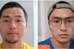 蕪湖眼科醫(yī)院（弋江區(qū)醫(yī)院）史椰欖整形價(jià)格表附切開雙眼皮案例展示