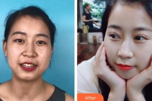 蕪湖眼科醫(yī)院（弋江區(qū)醫(yī)院）晉毓信整形價(jià)格表附雙眼皮案例展示