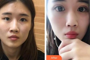 蕪湖眼科醫(yī)院（弋江區(qū)醫(yī)院）王國平整形價(jià)格表附切開雙眼皮案例展示