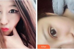 蕪湖眼科醫(yī)院（弋江區(qū)醫(yī)院）孫功勛整形價(jià)格表附雙眼皮案例展示