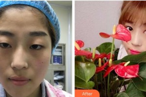 蕪湖眼科醫(yī)院（弋江區(qū)醫(yī)院）周仕福整形價(jià)格表附雙眼皮案例展示