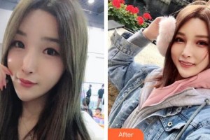 蕪湖愛爾眼科醫(yī)院王飛整形價(jià)格表附眼部修復(fù)案例展示