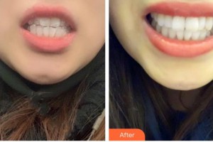 蕪湖市口腔醫(yī)院張彪整形價(jià)格表附隱形托槽矯正案例展示