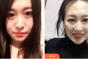 蕪湖新時(shí)代口腔門診部顧瑩整形價(jià)格表附金屬托槽矯正案例展示