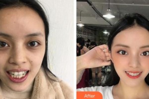 蕪湖來友口腔門診部陳天蘊(yùn)整形價(jià)格表附牙齒矯正案例展示