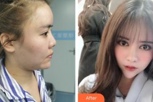 蚌埠醫(yī)學(xué)院第二附屬醫(yī)院整形外科陶思一整形價(jià)格表附鼻部手術(shù)案例展示