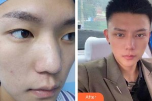 蚌埠美萊塢整形美容醫(yī)院蔣興貌整形價(jià)格表附膨體隆鼻案例展示