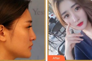 蚌埠華美整形美容門診部趙輯整形價(jià)格表附鼻部綜合案例展示