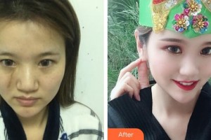 蚌埠韓麗整形美容醫(yī)院梁青整形價(jià)格表附疤痕祛除案例展示
