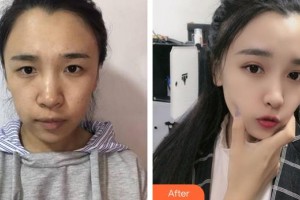 蚌埠市第三人民醫(yī)院燒傷整形科李方奇整形價(jià)格表附眼部綜合案例展示