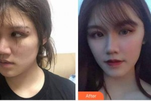 蚌埠韓麗整形美容醫(yī)院洪志堅(jiān)整形價(jià)格表附埋線提升案例展示