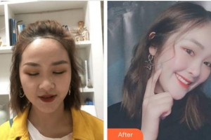 蚌埠韓麗整形美容醫(yī)院柳熙中整形價(jià)格表附種植發(fā)際線案例展示