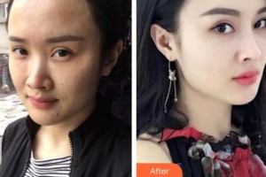 蚌埠韓麗整形美容醫(yī)院康寶峰整形價(jià)格表附熱瑪吉案例展示