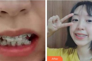 蚌埠華美整形美容門診部楊松整形價(jià)格表附牙齒陶瓷矯正案例展示