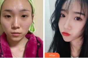 蚌埠韓麗整形美容醫(yī)院李準(zhǔn)馥整形價(jià)格表附顴骨內(nèi)推案例展示