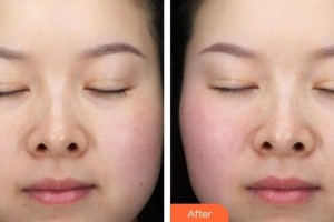 蚌埠韓麗整形美容醫(yī)院安泰柱整形價(jià)格表附面部輪廓案例展示