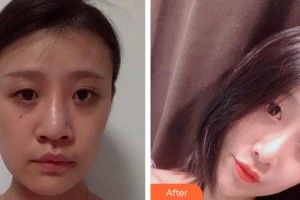 蚌埠韓麗整形美容醫(yī)院樸鐘范整形價(jià)格表附鼻部整形案例展示