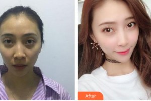 蚌埠美萊塢整形美容醫(yī)院潘志強(qiáng)整形價(jià)格表附自體脂肪填充案例展示